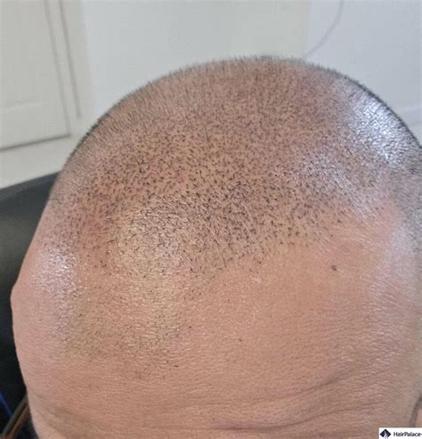 scalp micropigmentation regret|Iba pa.